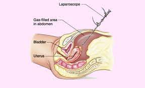 Hysteroscopy/ Laparoscopy